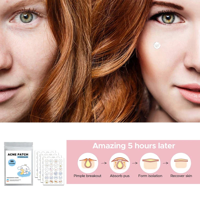 96pcs Hydrocolloid Acne Patches – Cute Character-Themed Pimple Stickers (Pastel Bunny, Cloud Friend, Sweet Kitty)