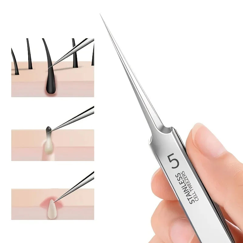 Precision Stainless Steel Acne & Blackhead Tweezers – Professional Skin Care Tool